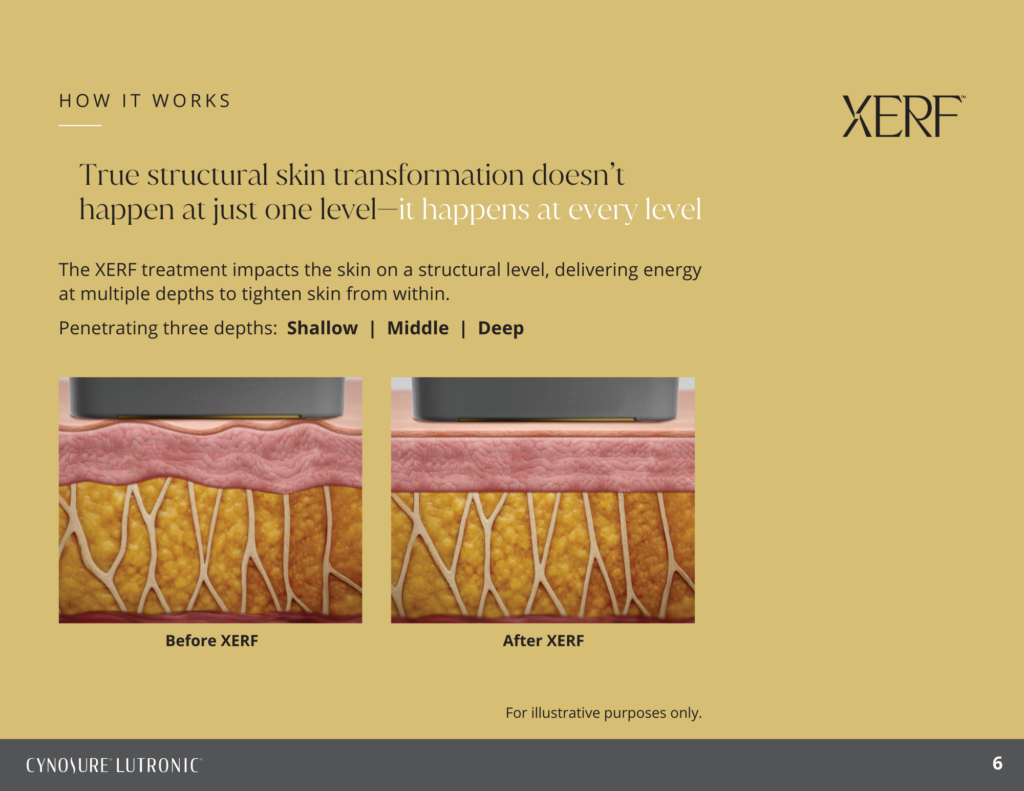 About Xerf Skin Tightening Page 5