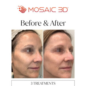 Mosaic 3D Before & After Image 1