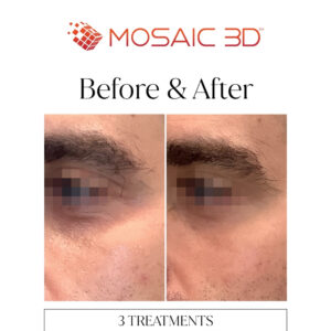 Mosaic 3D Before & After Image 2