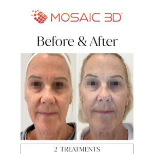 Mosaic 3D Before & After Image 3