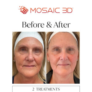 Mosaic 3D Before & After Image 4