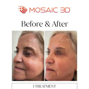 Mosaic 3D Before & After Image 5