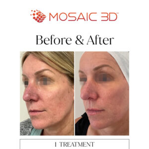 Mosaic 3D Before & After Image 6