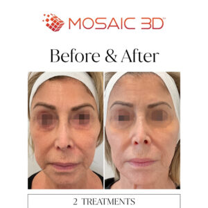 Mosaic 3D Before & After Image 7