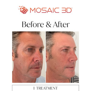 Mosaic 3D Before & After Image 8